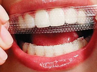 Средства для отбеливания зубов в домашних условиях