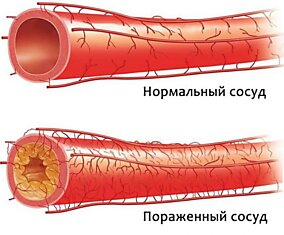 Доказано! Отказ от животного белка лечит атеросклероз