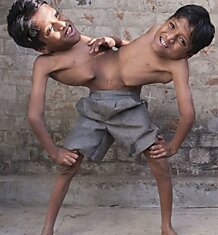 Сиамские близнецы в Индии стали новым божеством
