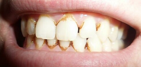 Средство, которое борется с зубным камнем лучше ультразвука!