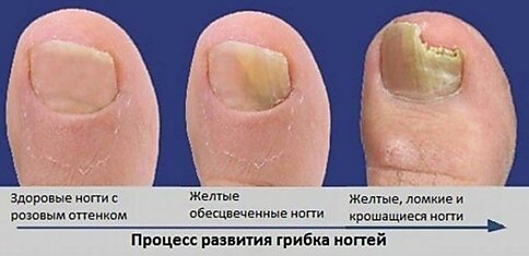 Как вылечить грибок на ногтях: Практические советы