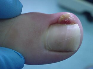 Осторожно, это заболевание может привести к ампутации пальца! Узнай всю правду о вросшем ногте.