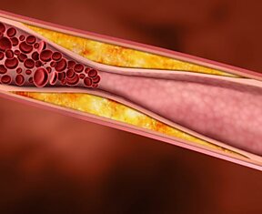Как понизить холестерин без лекарств и очистить сосуды