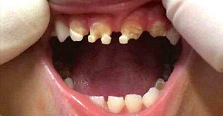 Когда врач увидел зубы 3-летнего ребенка, он задал матери всего один вопрос…