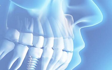 Імплантація зубів у Києві в пішій доступності від метро Лівобережна