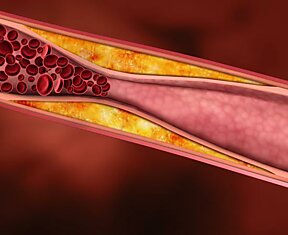 На самом деле холестерин почти не влияет на болезни сердца и сосудов