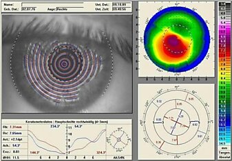 Побочные эффекты лазерной коррекции зрения