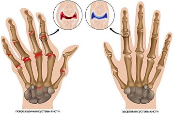 Упражнения для лечения артроза пальцев рук