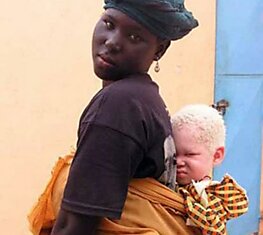 Альбинизм - дар или проклятие?