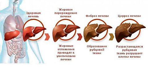 Мягкое очищении печени по методике Андреаса Морица