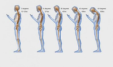 Что такое «смартфоновая шея» и как исправить осанку