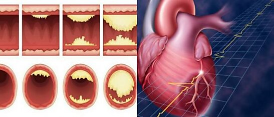 15 лучших продуктов для очищения артерий и профилактики инфаркта миокарда: живи дольше!