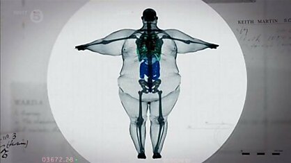 Рентгеновская фотография толстого человека - кость не широкая
